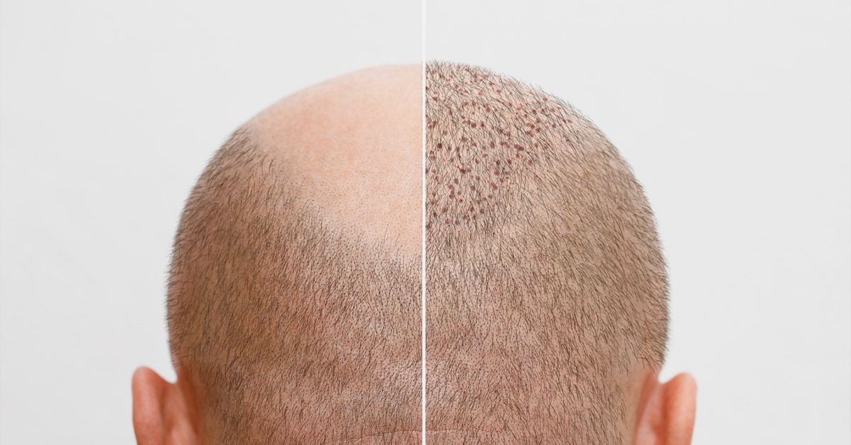 Do Hair Transplants Work?