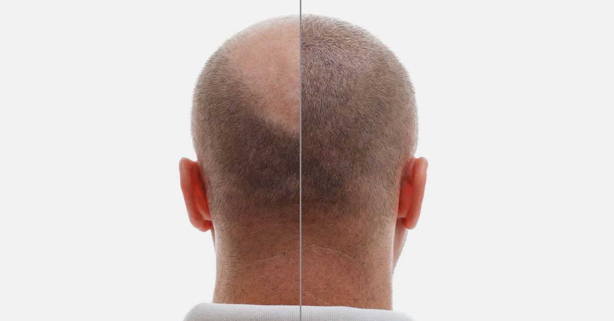 Timeline of Hair Transplant