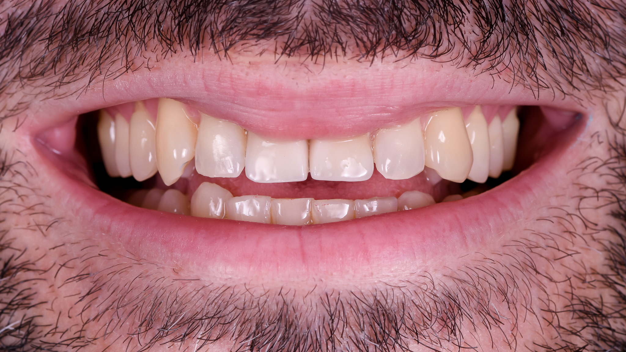 Implantációs eset digitális tervezéssel