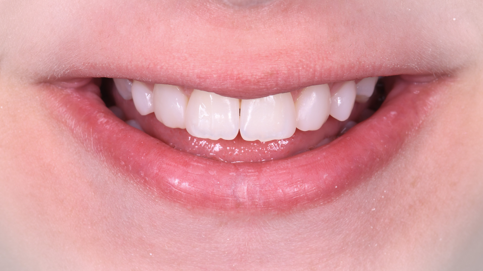 Helykitöltő kép előtte -utána kompozícióhoz