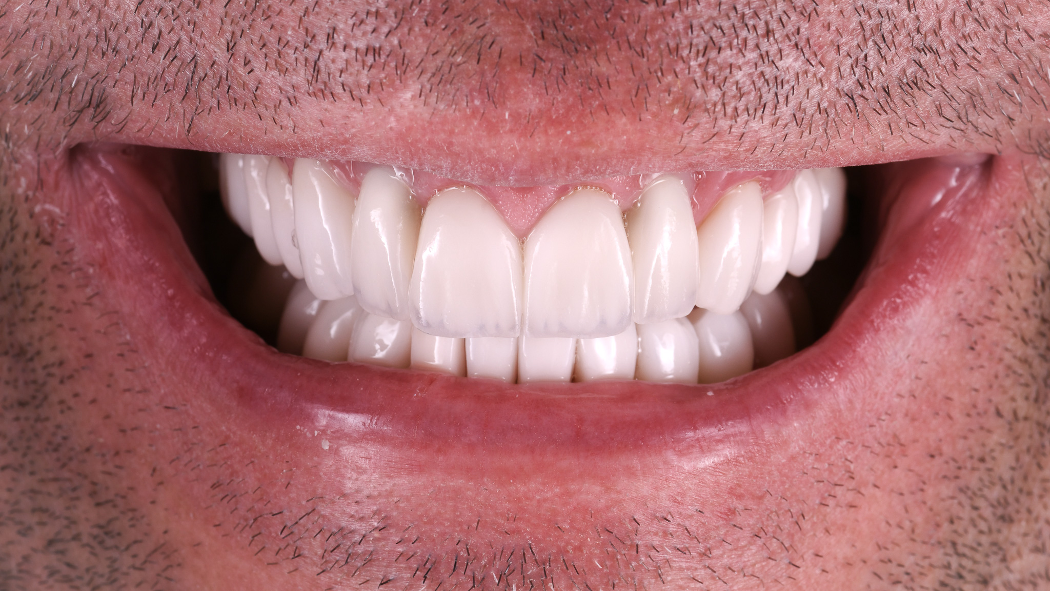 Helykitöltő kép előtte -utána kompozícióhoz