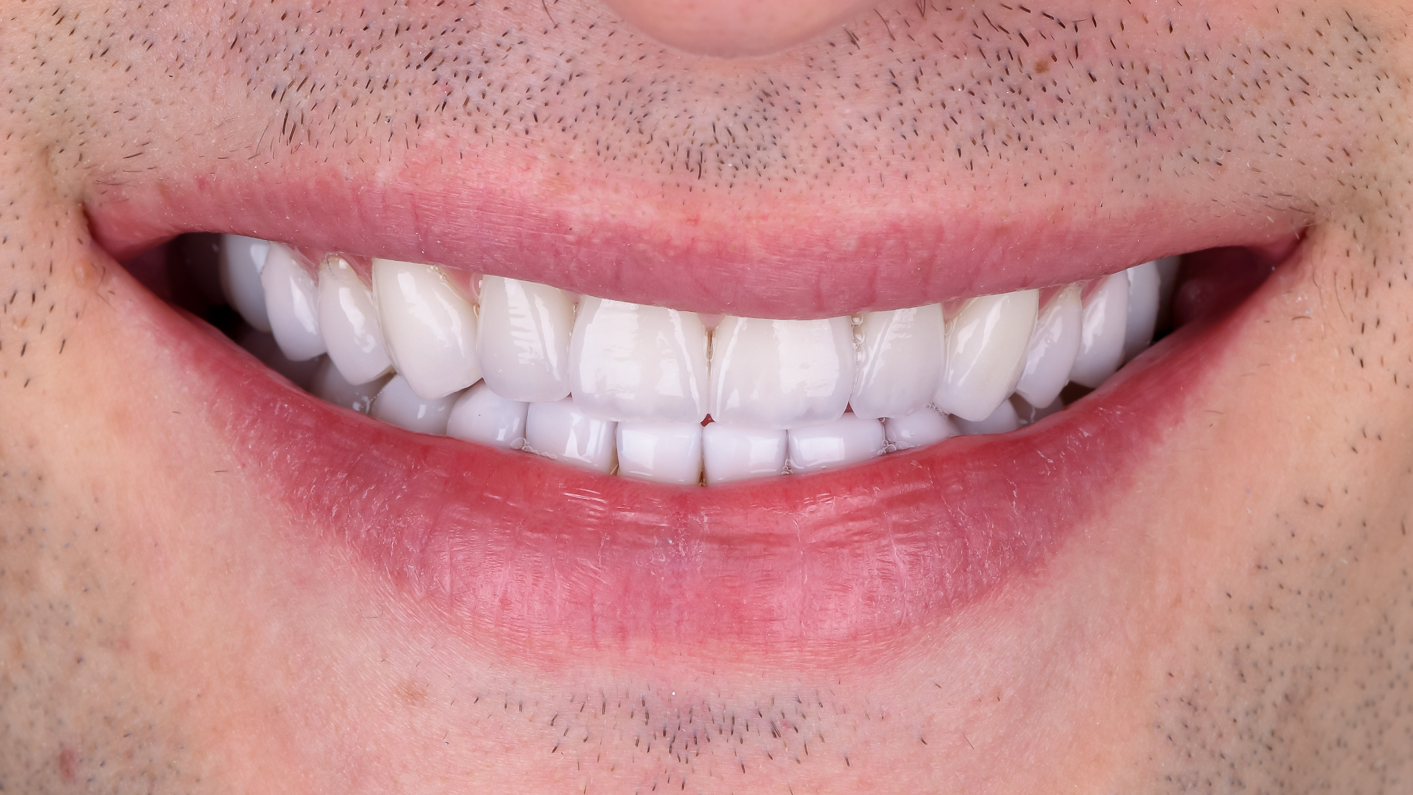 Helykitöltő kép előtte -utána kompozícióhoz