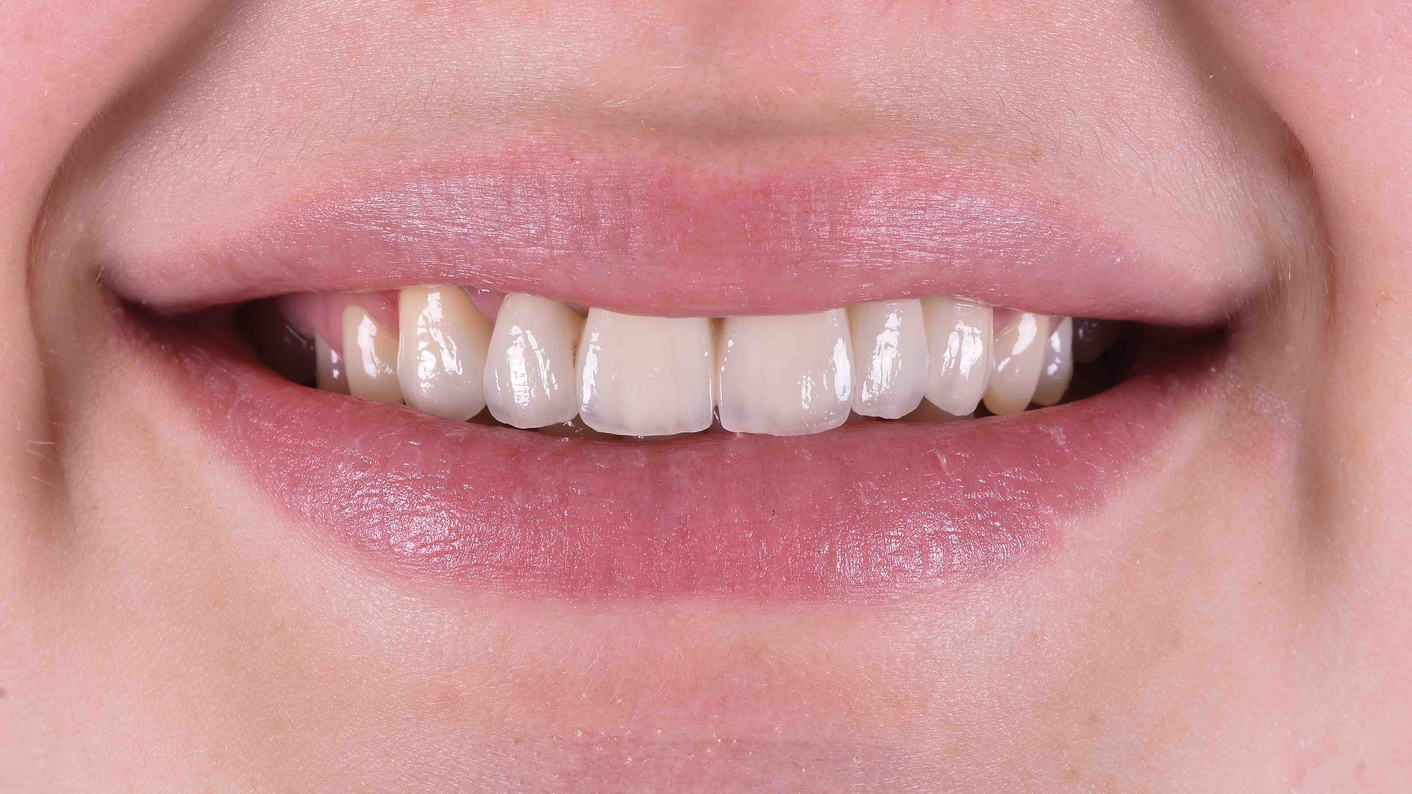 Mikroszkópos gyökérkezelés fogmentéssel