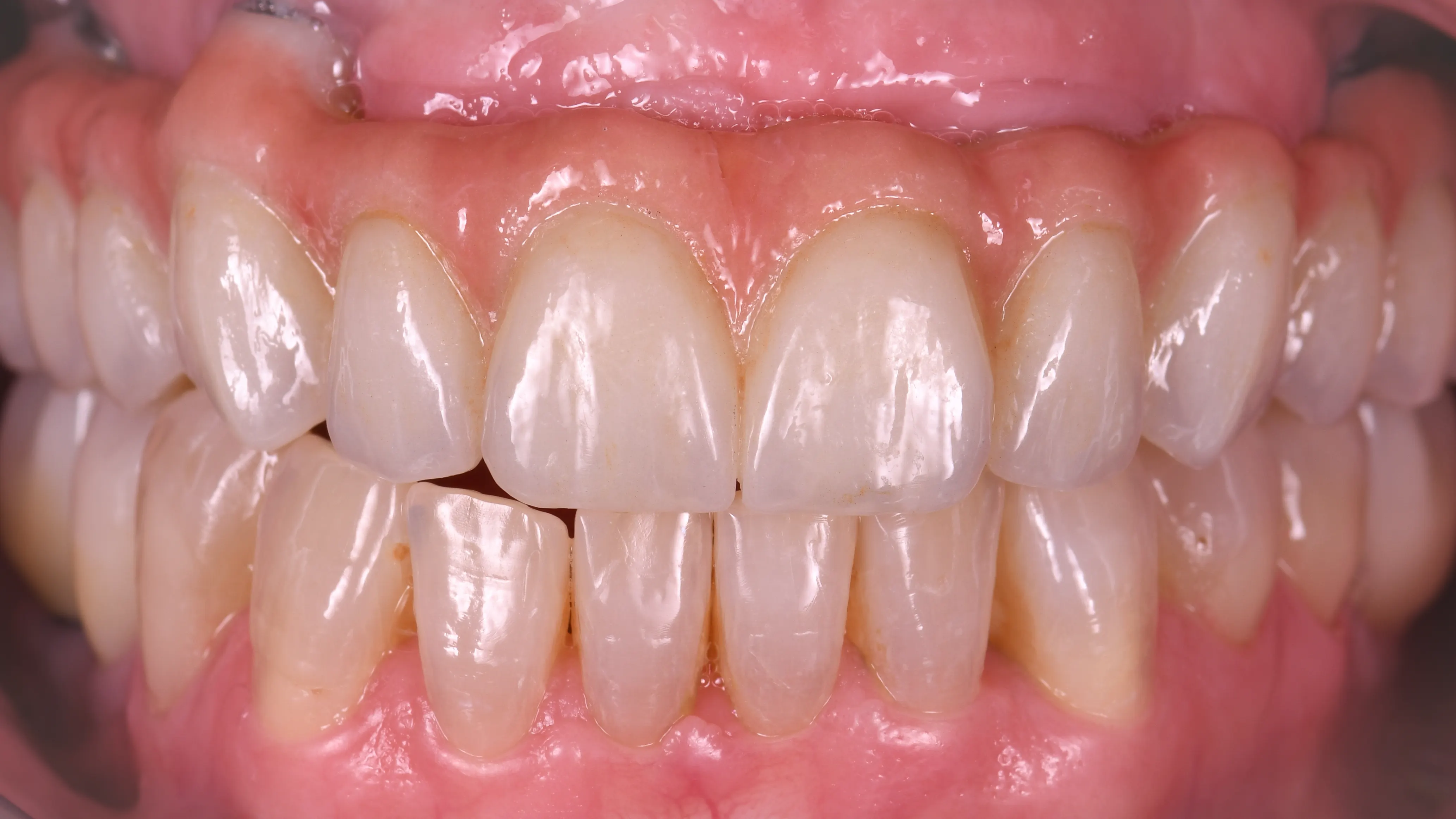 Implantációs eset digitális tervezéssel