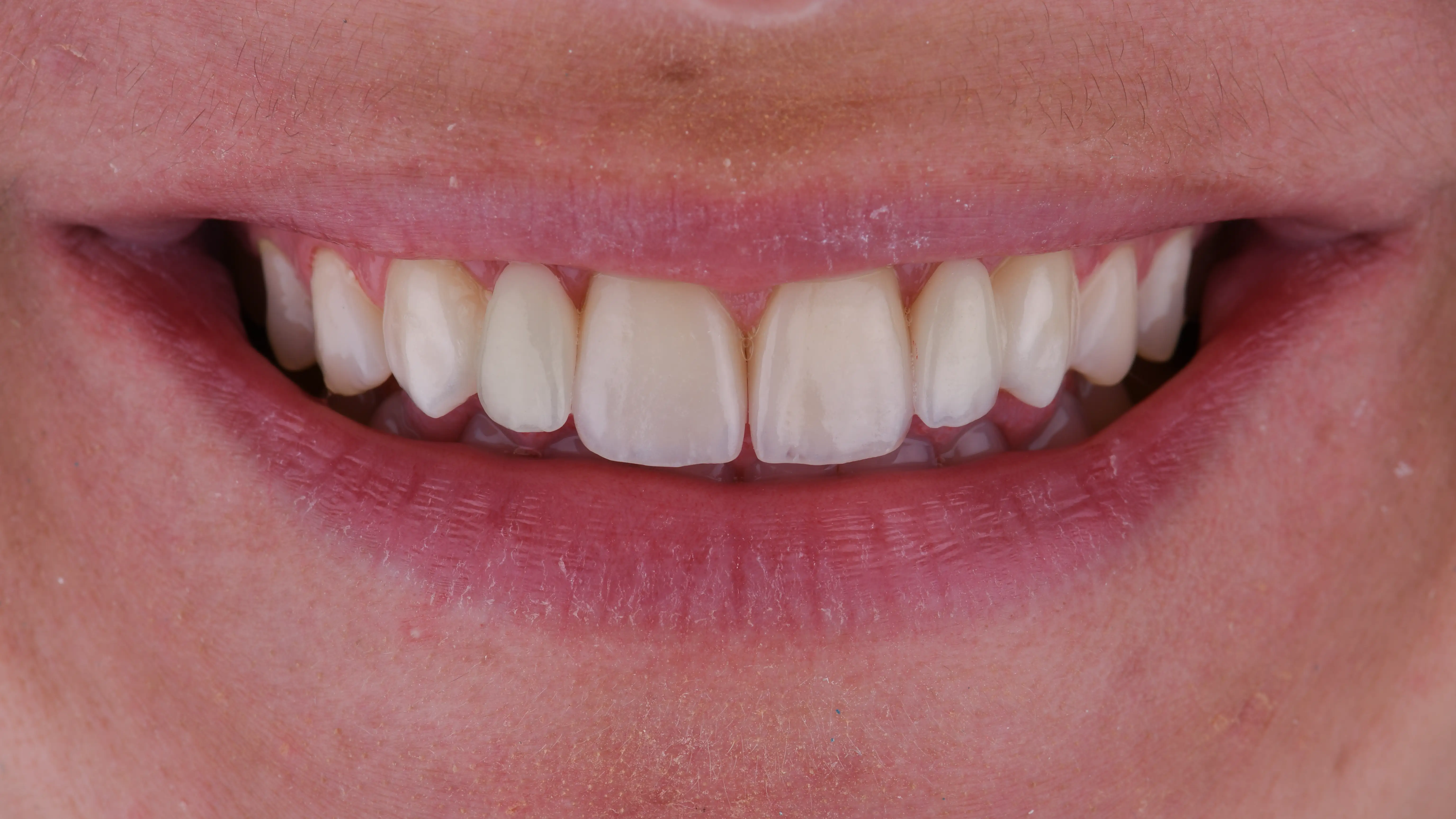 Kerámia héj mosolyátalakítás finom arányokkal